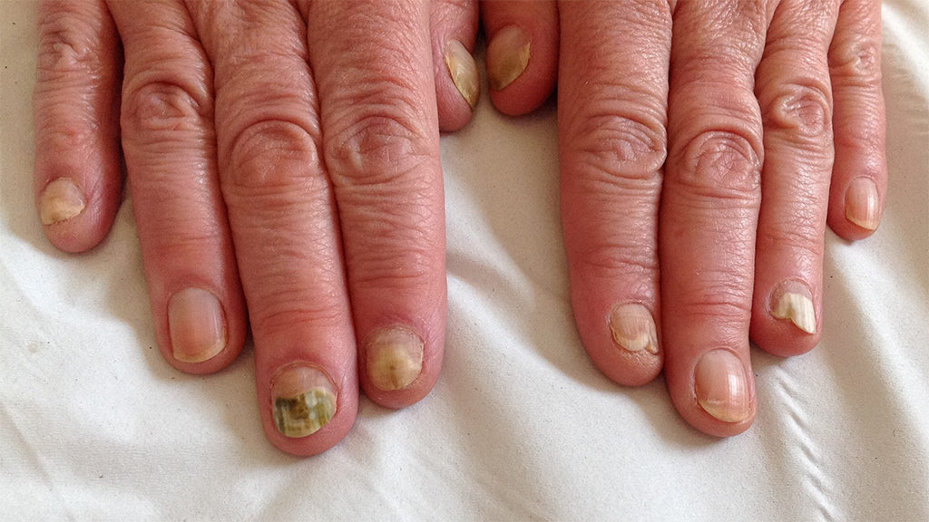 Paronychia Disease of the Fingernail Sensation Skin Aches Redness Disease  Painful Healing Painful Problem Stock Photo - Image of liquid, abscess:  253760754