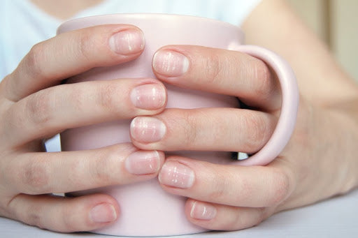 How to Easily and Safely Treat Nail Psoriasis