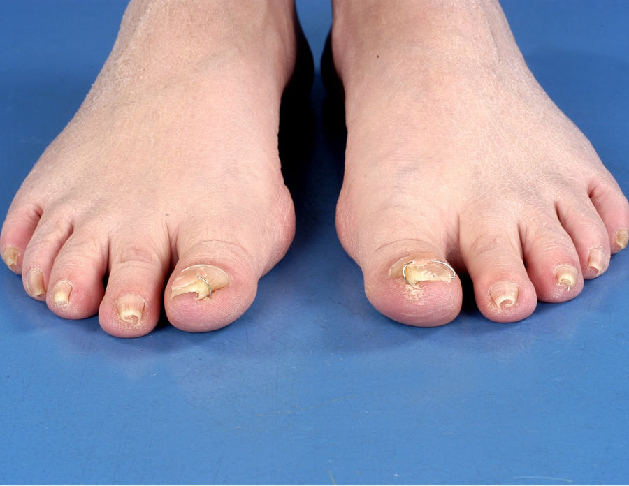 Pincer Toenails: Causes, Treatment, and When to See a Podiatrist (2026 ...