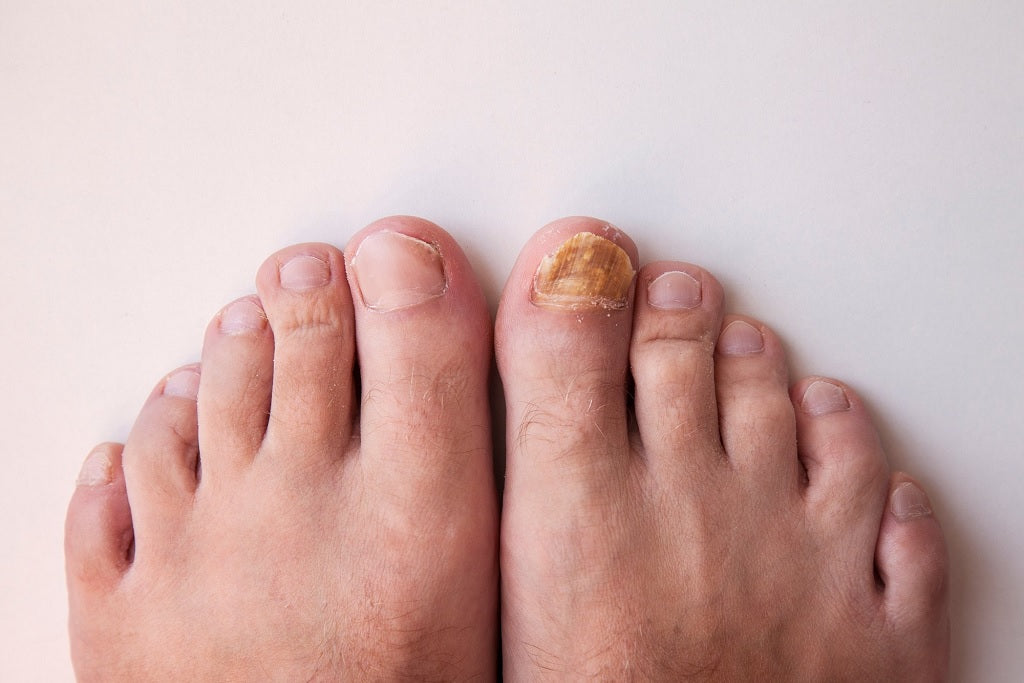 How to Get Rid of Nail Fungus on Toes