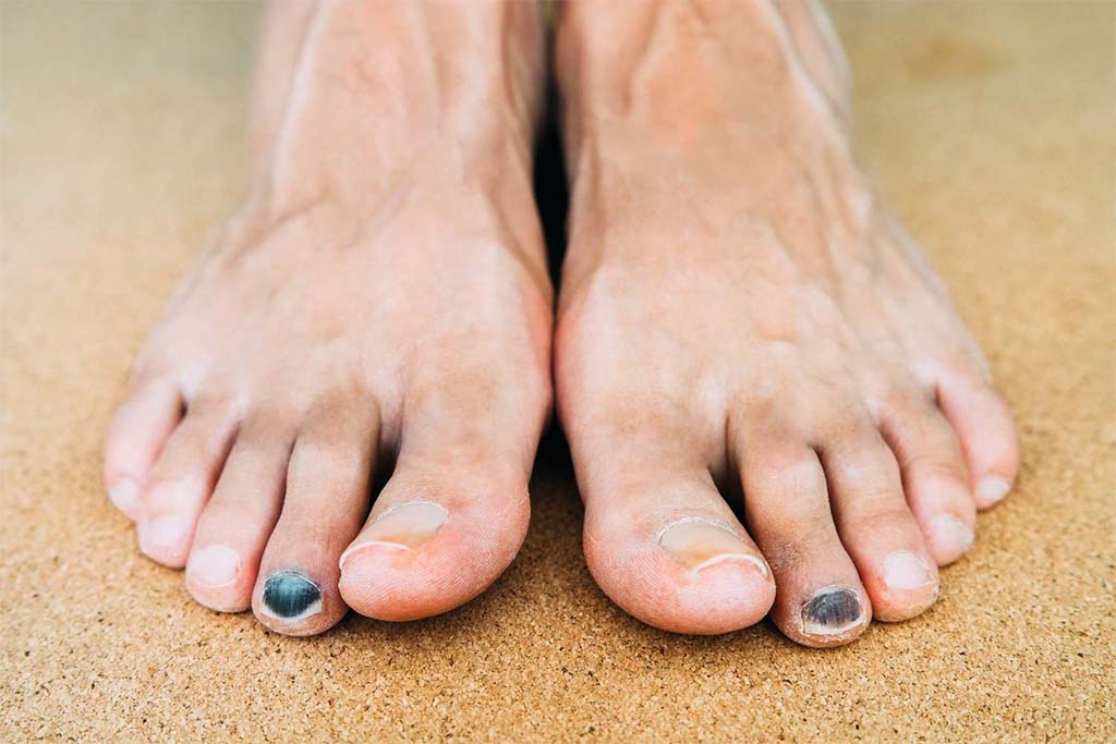 How to Heal a Bruised Toenail?