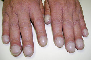 Understanding Nail Clubbing